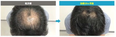 AGAオンクリ治療症例写真