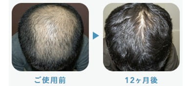 Oops HAIR（ウープス　ヘア）症例写真