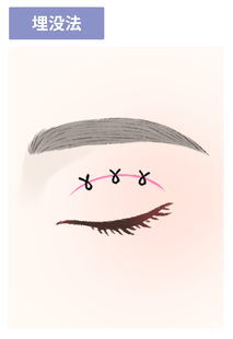 埋没法のイラスト