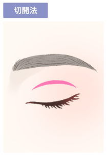 切開法のイラスト